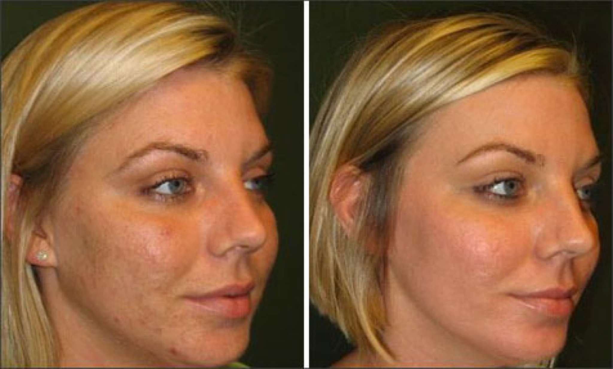 Chemical Peels before and after