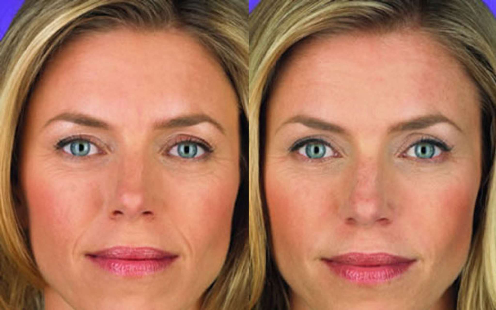 Derma Fillers - before and after