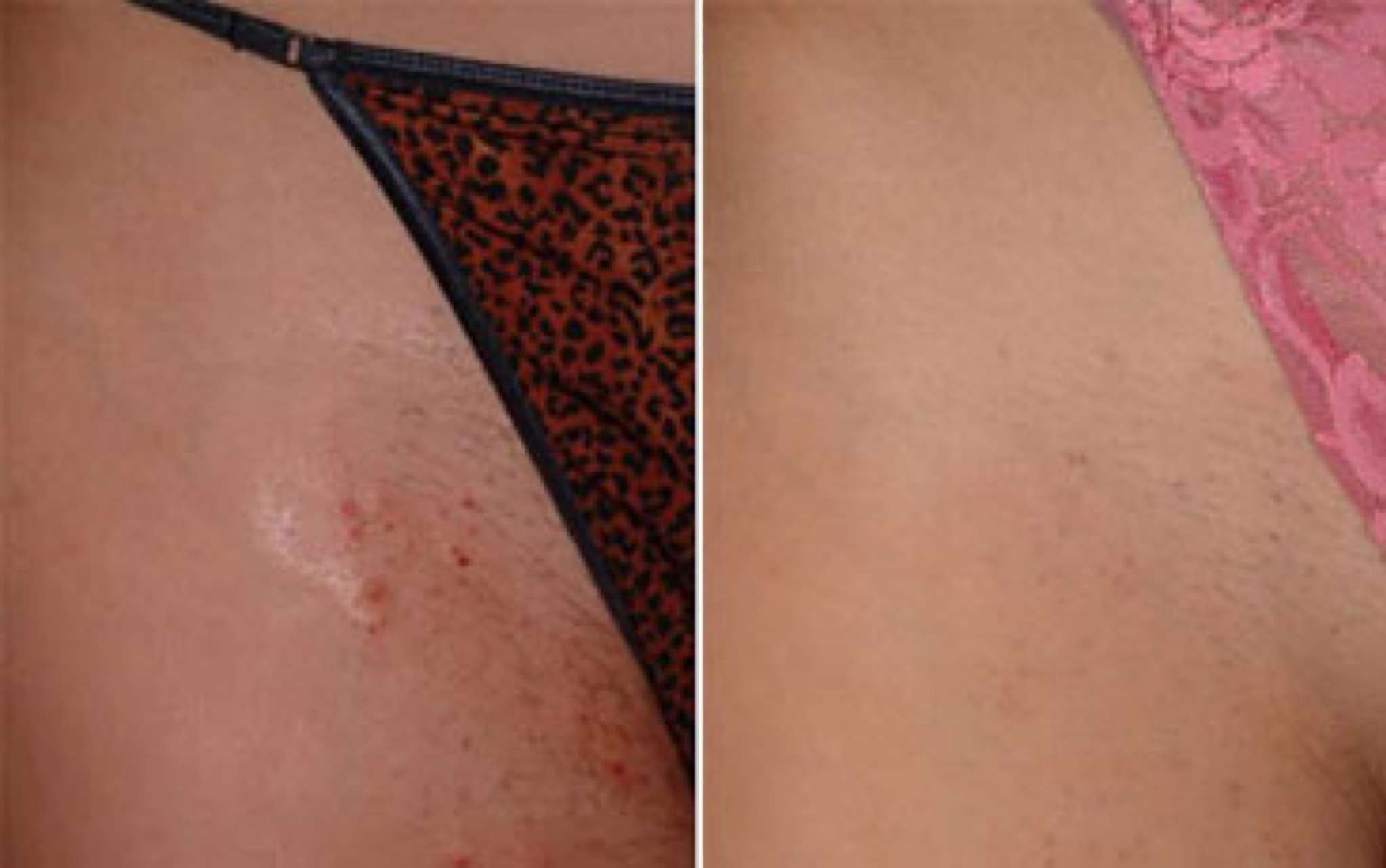 Laser hair removal-before-after