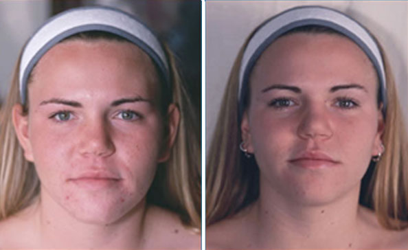 Microdermabrasion - Before and after