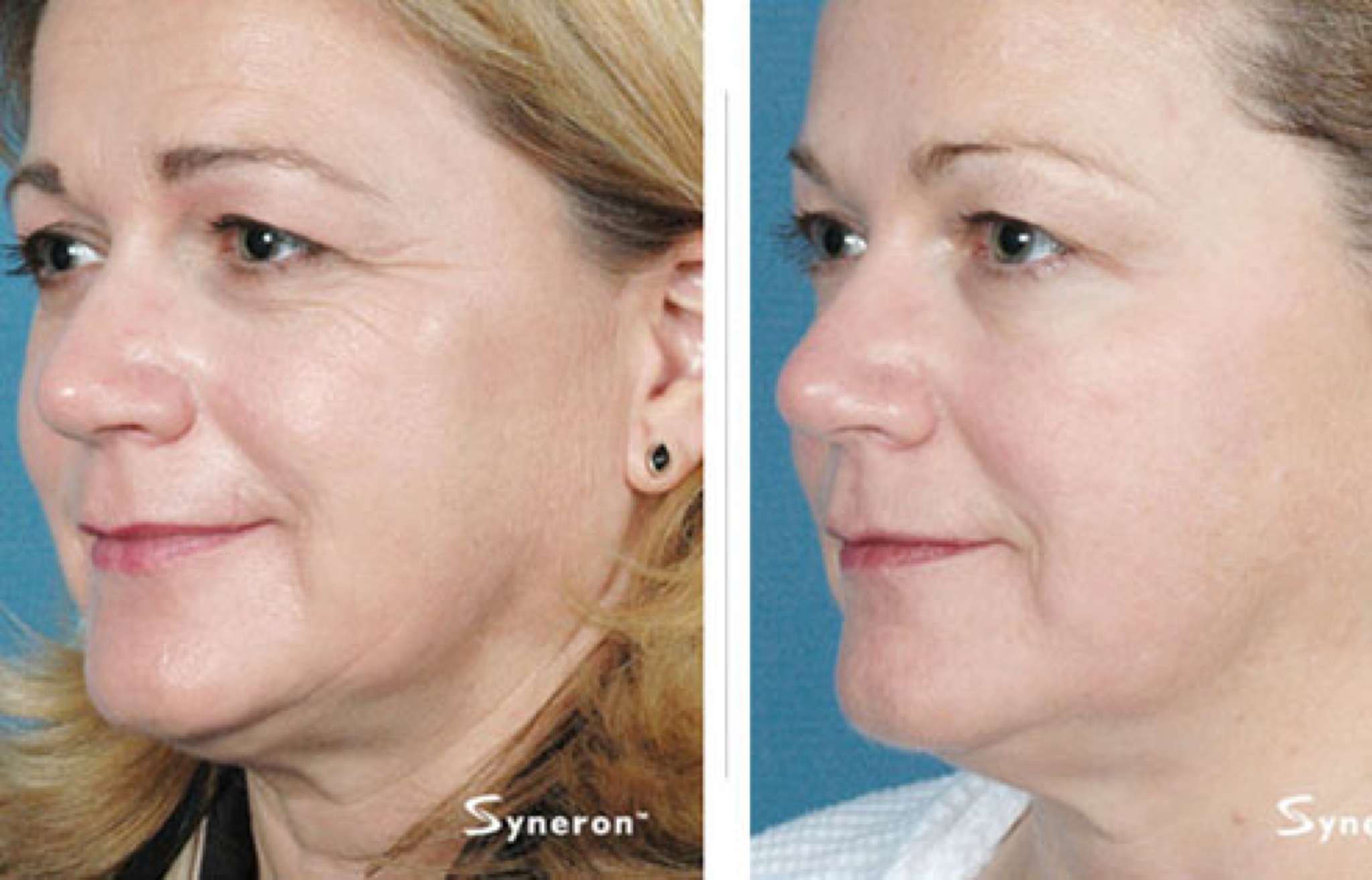 ReFirme - Skin Tightening​ before and after Doral Miami