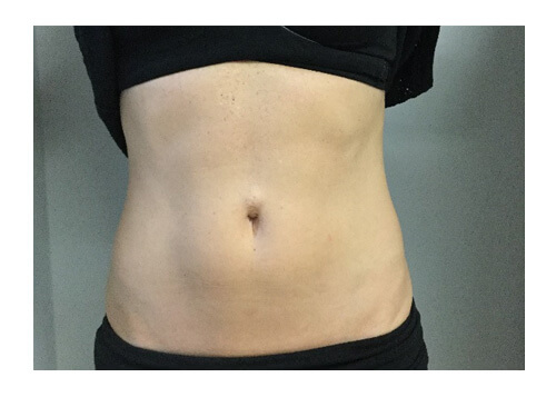 Velashape 3 Before and after shots
