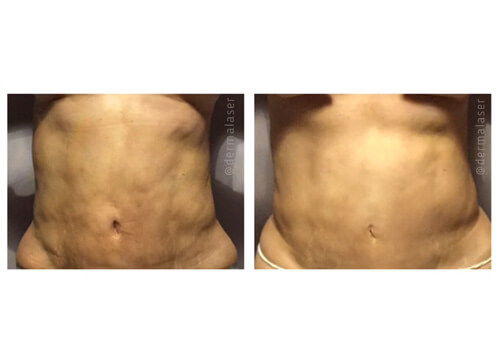 Velashape 3 Before and after shots