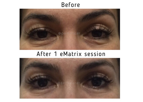 eMatrix images of application before and after